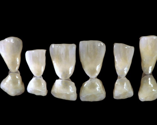 Veneers